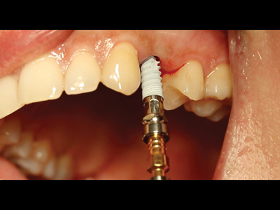 Antal-30.-Implant-insertion- 1