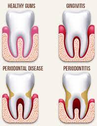Periodontal & Gum Surgery 4