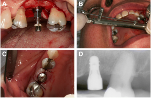 Implant Insertion