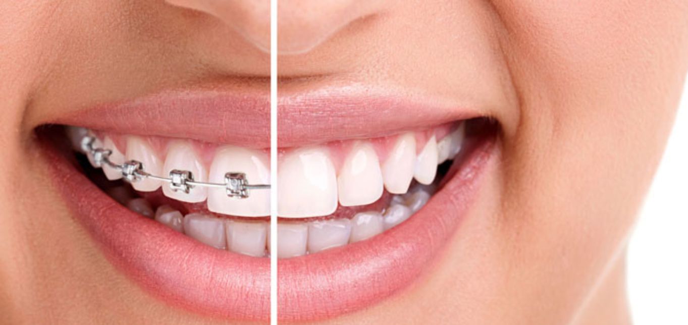 Orthodontic Treatment: A Comprehensive Guide