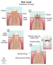 root canal