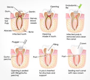 root canal