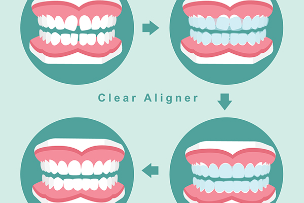 before and after of teeth with orthodontic braces , clear aligner ,vector illustration.
